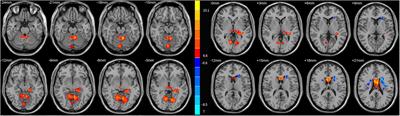 Abnormal degree centrality values as a potential imaging biomarker for major depressive disorder: A resting-state functional magnetic resonance imaging study and support vector machine analysis